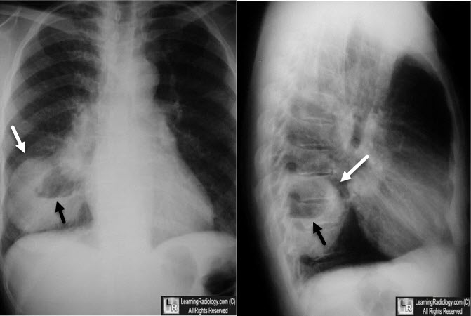 Cavitating Bronchogenic Carcinoma